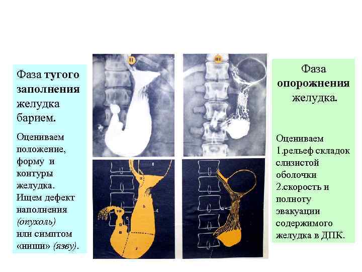 Фаза тугого заполнения желудка барием. Оцениваем положение, форму и контуры желудка. Ищем дефект наполнения