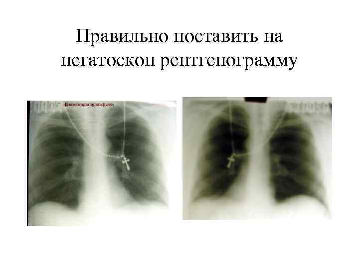 Правильно поставить на негатоскоп рентгенограмму 