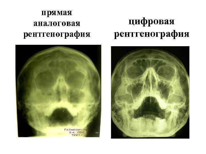 прямая аналоговая рентгенография цифровая рентгенография 