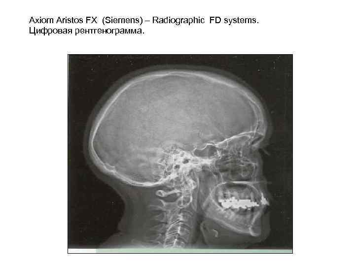 Axiom Aristos FX (Siemens) – Radiographic FD systems. Цифровая рентгенограмма. 