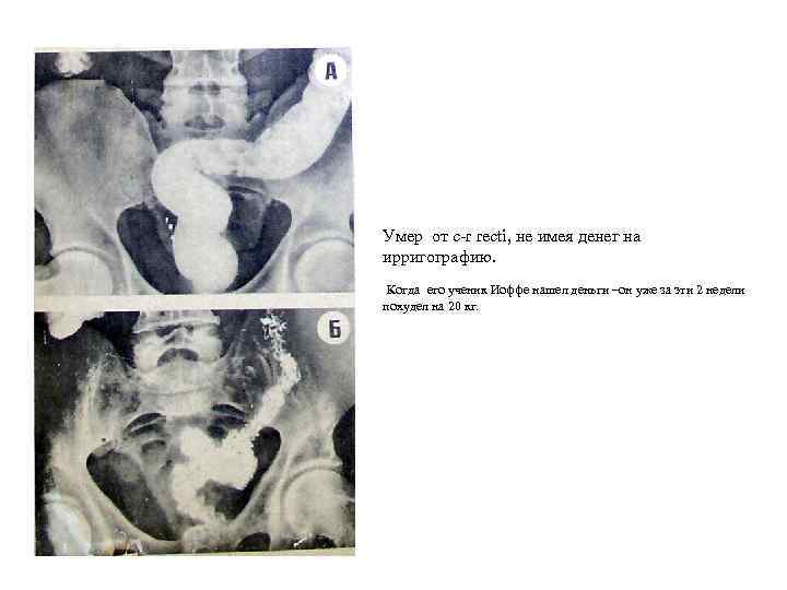 Умер от с-r recti, не имея денег на ирригографию. Когда его ученик Иоффе нашел