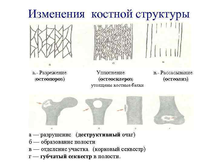 Изменения костной структуры а. - Разрежение (остеопороз) Уплотнение (остеосклероз) утолщены костные балки а —