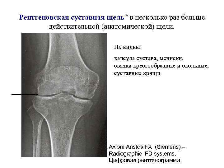 Рентгеновская суставная щель” в несколько раз больше действительной (анатомической) щели. Не видны: капсула сустава,