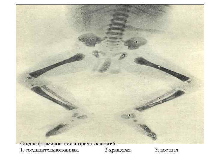 Стадии формирования вторичных костей: 1. соединительнотканная. 2. хрящевая 3. костная 
