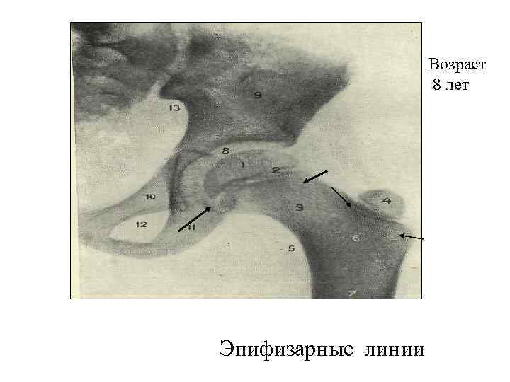 Возраст 8 лет Эпифизарные линии 