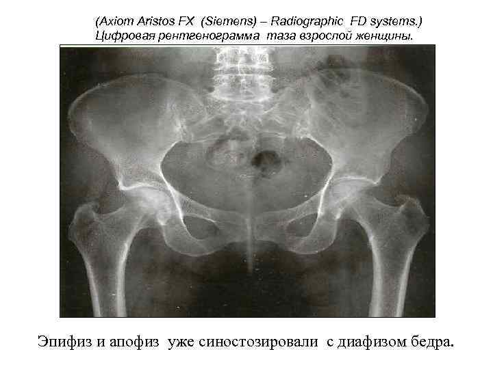 (Axiom Aristos FX (Siemens) – Radiographic FD systems. ) Цифровая рентгенограмма таза взрослой женщины.
