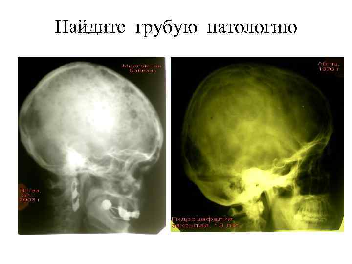 Найдите грубую патологию 