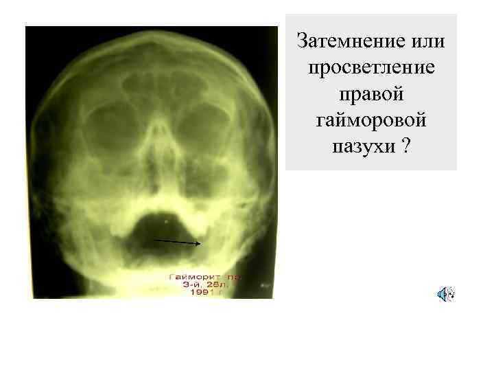 Затемнение или просветление правой гайморовой пазухи ? 