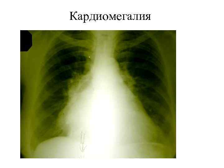 Кардиомегалия 