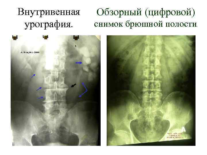 Внутривенная урография. А. К-ов, 54 г. -1999 г Обзорный (цифровой) снимок брюшной полости .