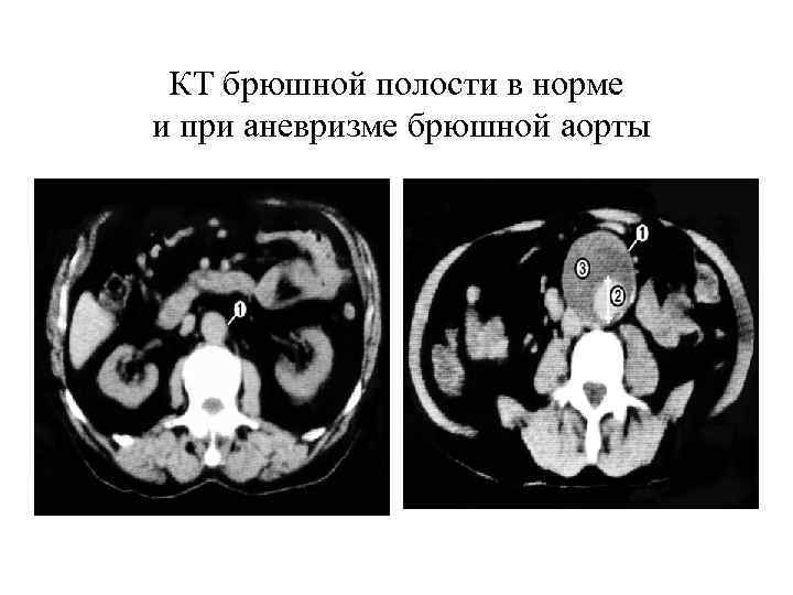 КТ брюшной полости в норме и при аневризме брюшной аорты 