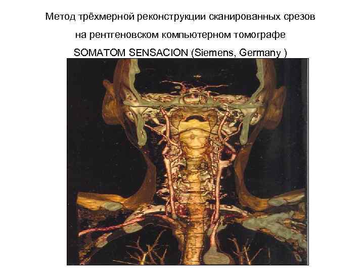 Метод трёхмерной реконструкции сканированных срезов на рентгеновском компьютерном томографе SOMATOM SENSACION (Siemens, Germany )