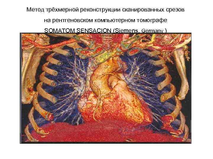 Метод трёхмерной реконструкции сканированных срезов на рентгеновском компьютерном томографе SOMATOM SENSACION (Siemens, Germany )