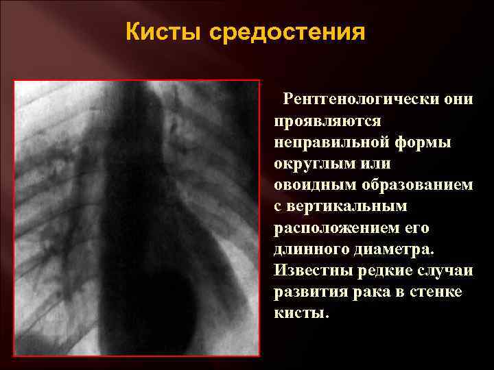 Кисты средостения Рентгенологически они проявляются неправильной формы округлым или овоидным образованием с вертикальным расположением