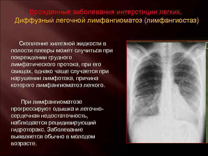 Врожденные заболевания интерстиции легких. Диффузный легочной лимфангиоматоз (лимфангиостаз) Скопление хилезной жидкости в полости плевры