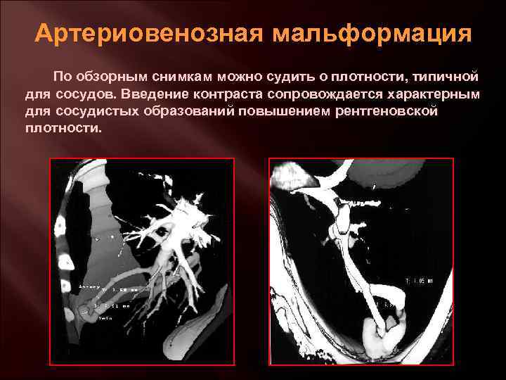 Артериовенозная мальформация По обзорным снимкам можно судить о плотности, типичной для сосудов. Введение контраста