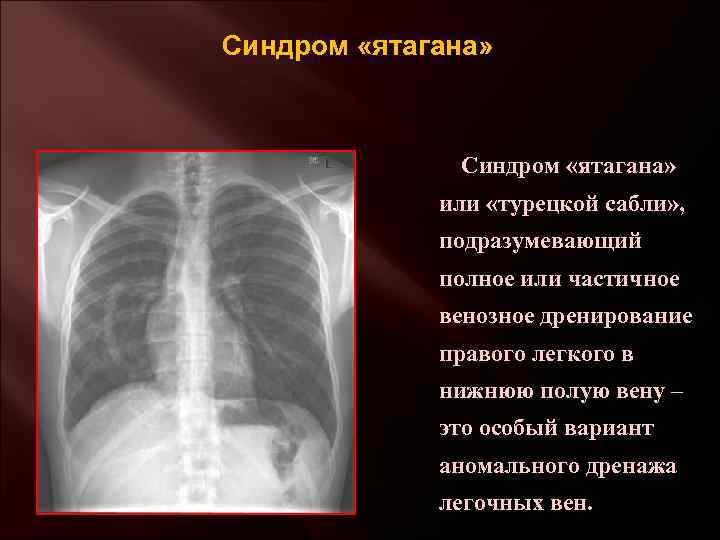 Синдром «ятагана» или «турецкой сабли» , подразумевающий полное или частичное венозное дренирование правого легкого