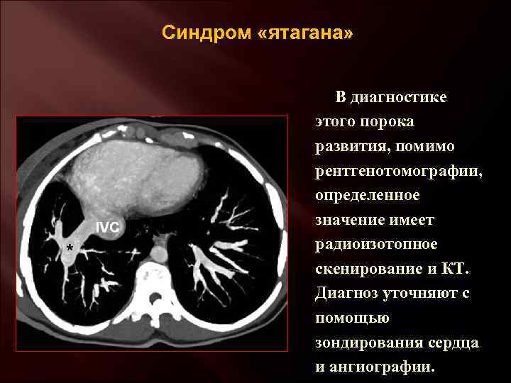 Синдром «ятагана» В диагностике этого порока развития, помимо рентгенотомографии, определенное значение имеет радиоизотопное скенирование