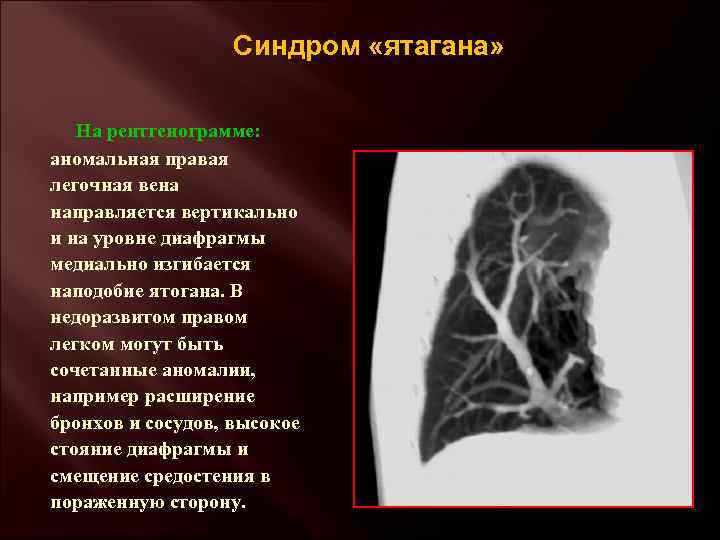 Синдром «ятагана» На рентгенограмме: аномальная правая легочная вена направляется вертикально и на уровне диафрагмы