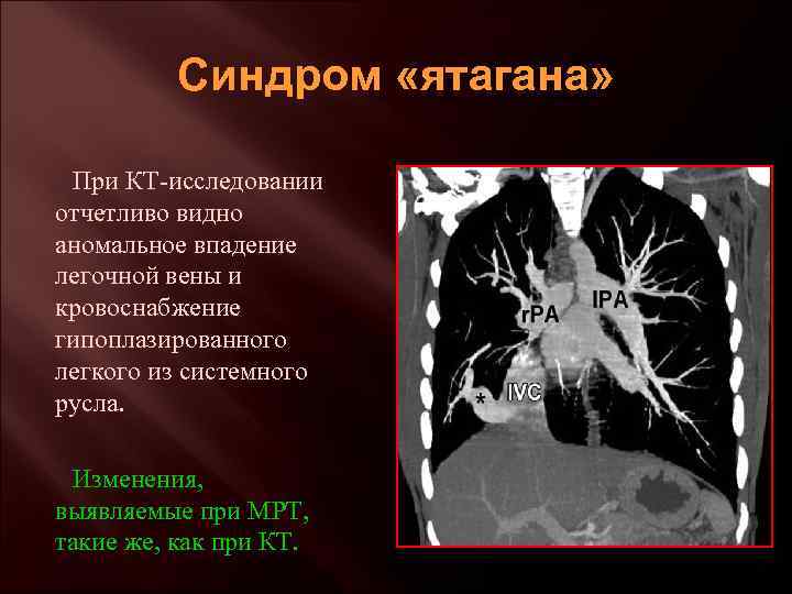 Синдром «ятагана» При КТ-исследовании отчетливо видно аномальное впадение легочной вены и кровоснабжение гипоплазированного легкого