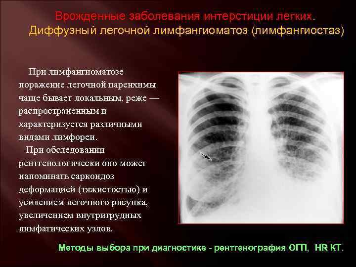 Врожденные заболевания интерстиции легких. Диффузный легочной лимфангиоматоз (лимфангиостаз) При лимфангиоматозе поражение легочной паренхимы чаще