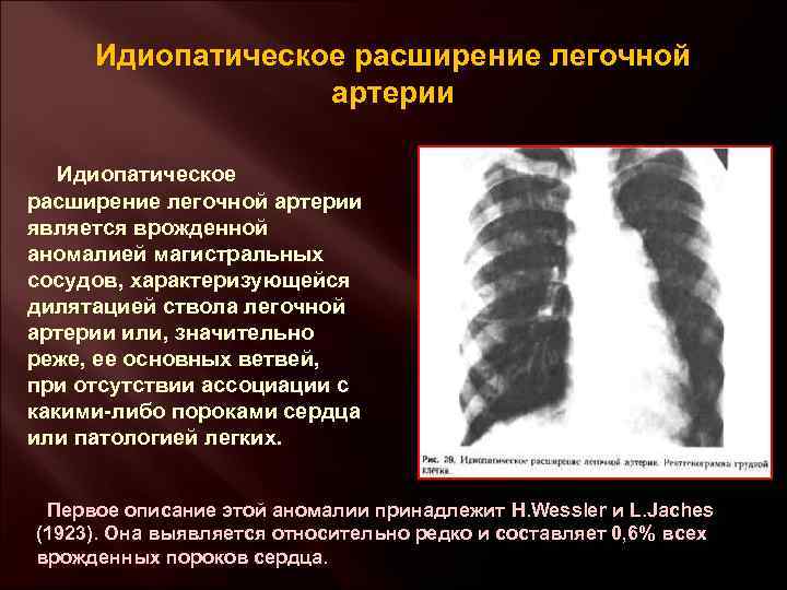 Идиопатическое расширение легочной артерии является врожденной аномалией магистральных сосудов, характеризующейся дилятацией ствола легочной артерии