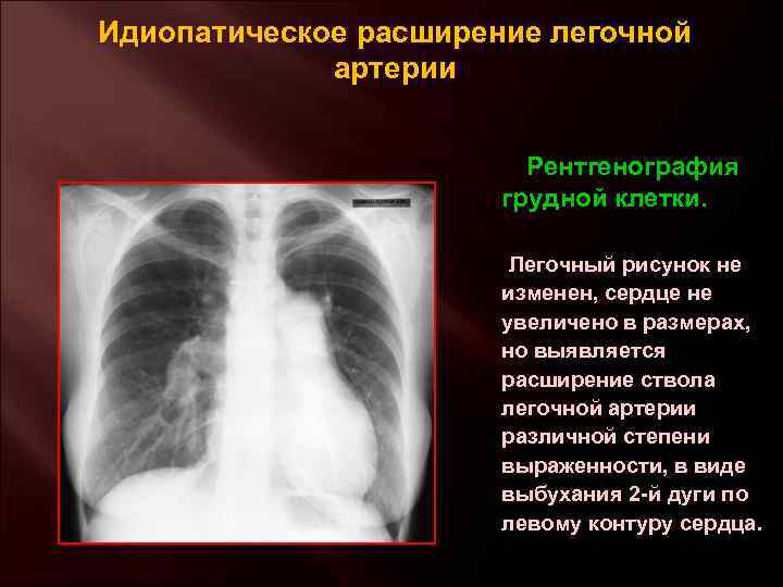 Идиопатическое расширение легочной артерии Рентгенография грудной клетки. Легочный рисунок не изменен, сердце не увеличено