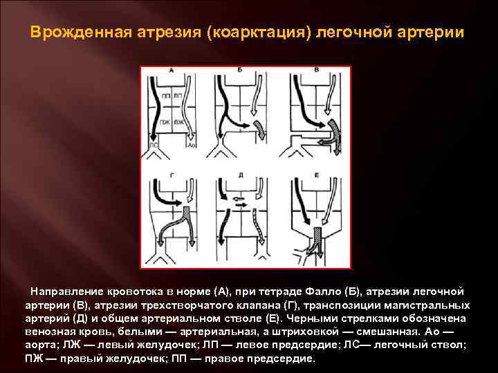 Клапан легочной артерии прослушивается