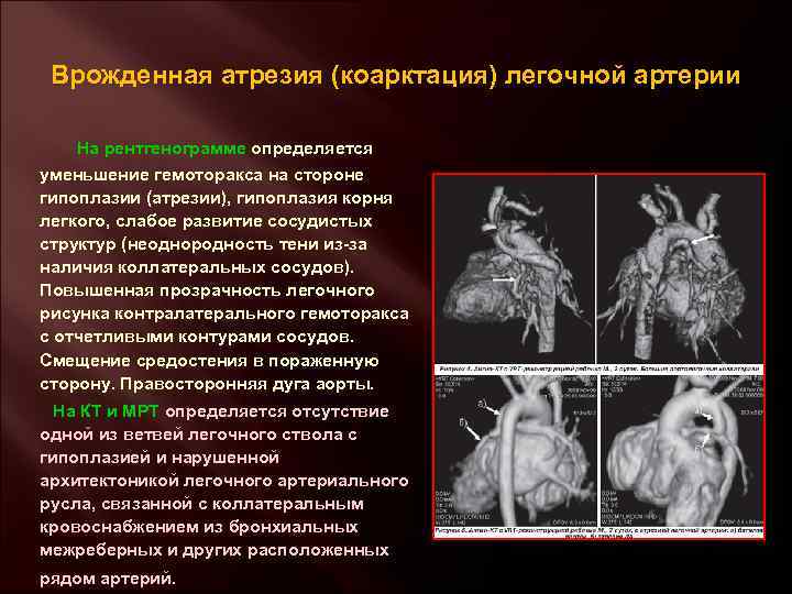 Врожденная атрезия (коарктация) легочной артерии На рентгенограмме определяется уменьшение гемоторакса на стороне гипоплазии (атрезии),