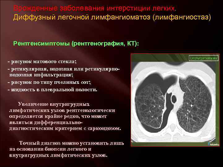 Врожденные заболевания интерстиции легких. Диффузный легочной лимфангиоматоз (лимфангиостаз) Рентгенсимптомы (рентгенография, КТ): - рисунок матового