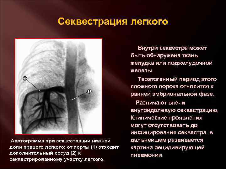 Секвестрация легкого Внутри секвестра может быть обнаружена ткань желудка или поджелудочной железы. Тератогенный период