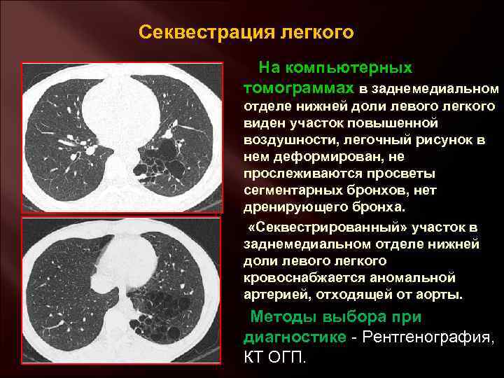 Секвестрация легкого На компьютерных томограммах в заднемедиальном отделе нижней доли левого легкого виден участок