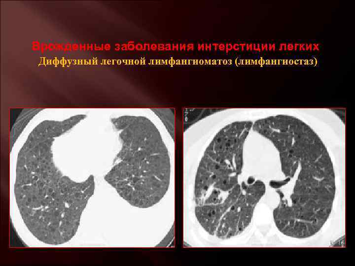 Врожденные заболевания интерстиции легких Диффузный легочной лимфангиоматоз (лимфангиостаз) 