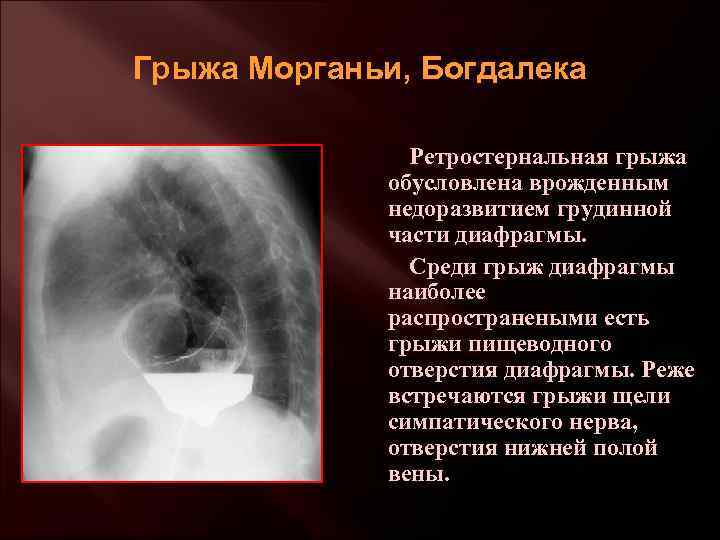 Грыжа Морганьи, Богдалека Ретростернальная грыжа обусловлена врожденным недоразвитием грудинной части диафрагмы. Среди грыж диафрагмы