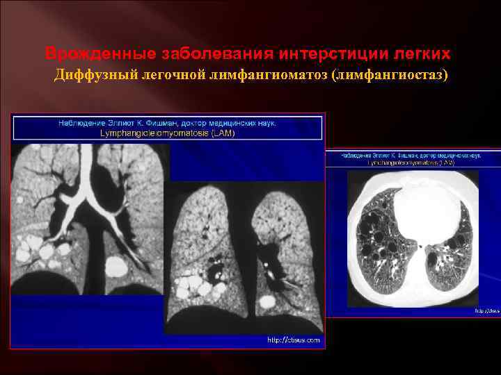 Врожденные заболевания интерстиции легких Диффузный легочной лимфангиоматоз (лимфангиостаз) 