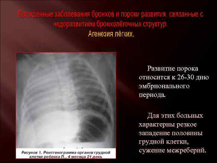  Развитие порока относится к 26 -30 дню эмбрионального периода. Для этих больных характерны