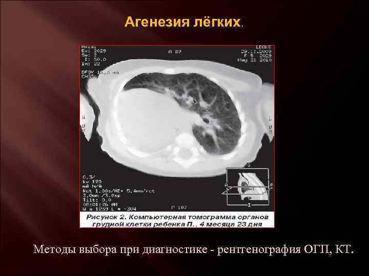 Агенезия лёгких. Методы выбора при диагностике - рентгенография ОГП, КТ. 