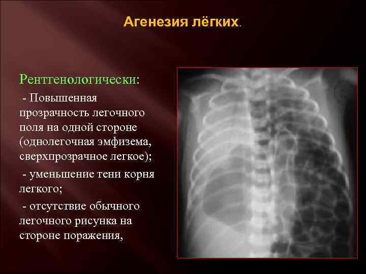 Агенезия лёгких. Рентгенологически: - Повышенная прозрачность легочного поля на одной стороне (однолегочная эмфизема, сверхпрозрачное