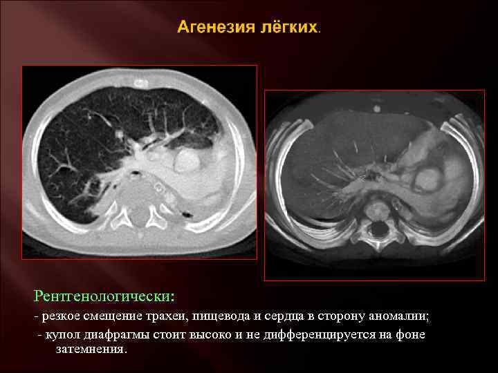 Рентгенологически: - резкое смещение трахеи, пищевода и сердца в сторону аномалии; - купол диафрагмы