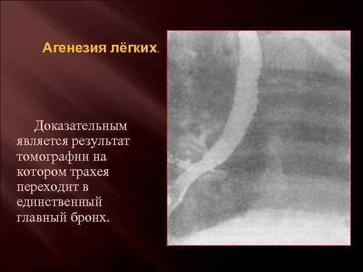 Агенезия лёгких. Доказательным является результат томографии на котором трахея переходит в единственный главный бронх.