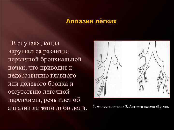 Аплазия лёгких В случаях, когда нарушается развитие первичной бронхиальной почки, что приводит к недоразвитию