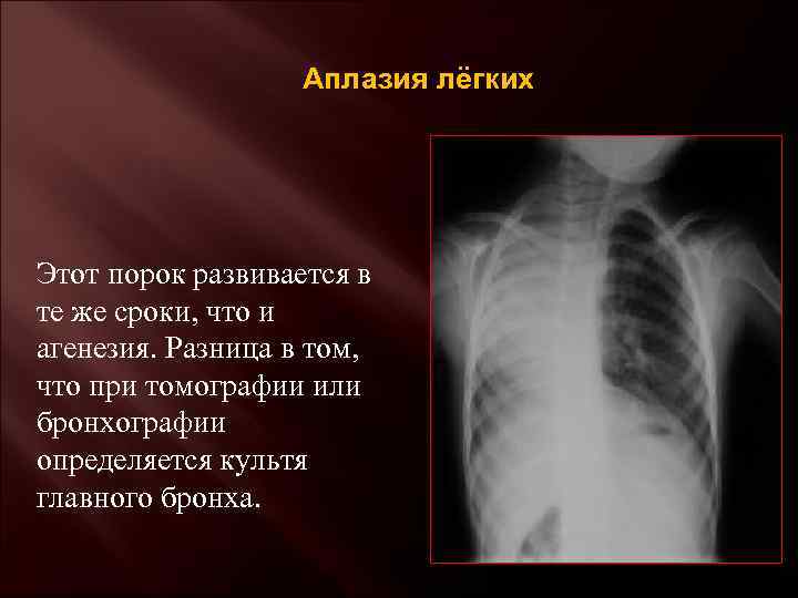 Аплазия лёгких Этот порок развивается в те же сроки, что и агенезия. Разница в