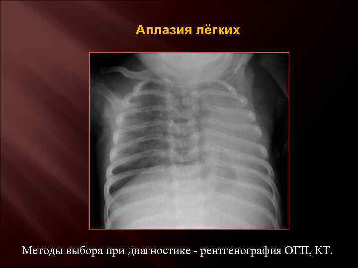 Аплазия лёгких Методы выбора при диагностике - рентгенография ОГП, КТ. 