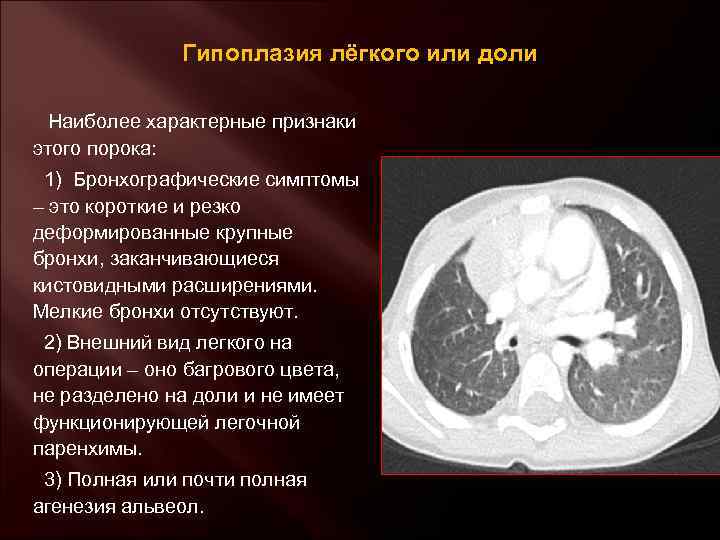  Гипоплазия лёгкого или доли Наиболее характерные признаки этого порока: 1) Бронхографические симптомы –