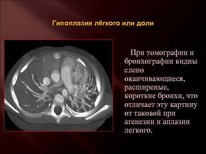 Гипоплазия лёгкого или доли При томографии и бронхографии видны слепо оканчивающиеся, расширеные, короткие бронхи,