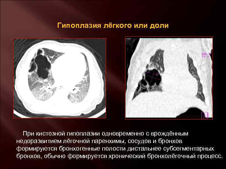 Гипоплазия лёгкого или доли При кистозной гипоплазии одновременно с врождённым недоразвитием лёгочной паренхимы, сосудов
