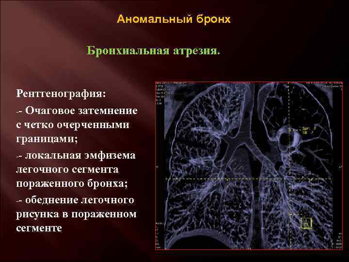 Аномальный бронх Бронхиальная атрезия. Рентгенография: -- Очаговое затемнение с четко очерченными границами; -- локальная