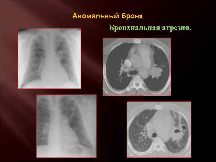 Аномальный бронх Бронхиальная атрезия. 