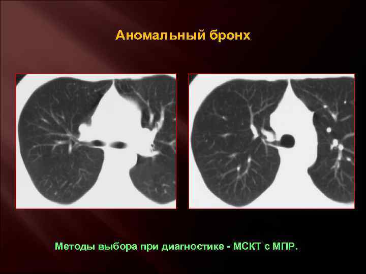 Аномальный бронх Методы выбора при диагностике - МСКТ с МПР. 