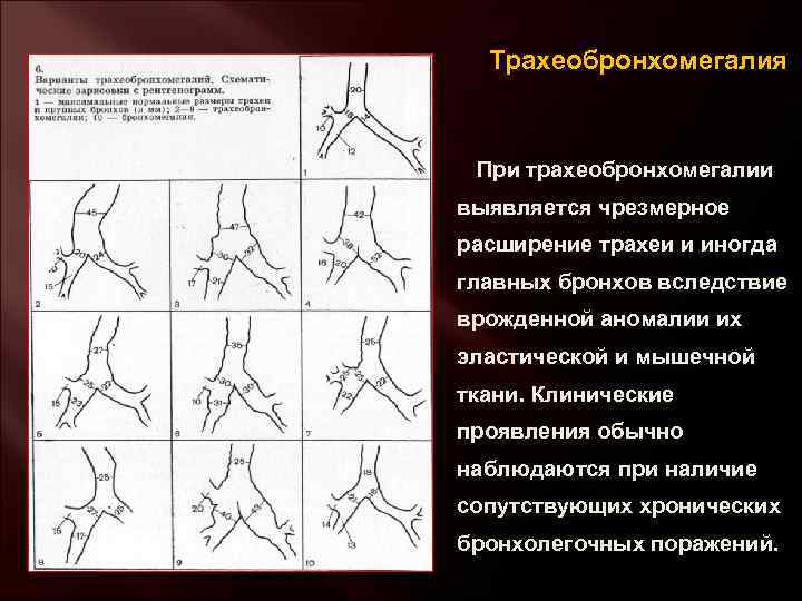 Трахеобронхомегалия При трахеобронхомегалии выявляется чрезмерное расширение трахеи и иногда главных бронхов вследствие врожденной аномалии